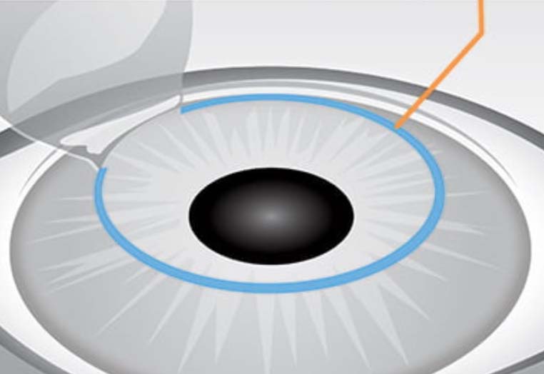 LASIK Opening ~ 20mm